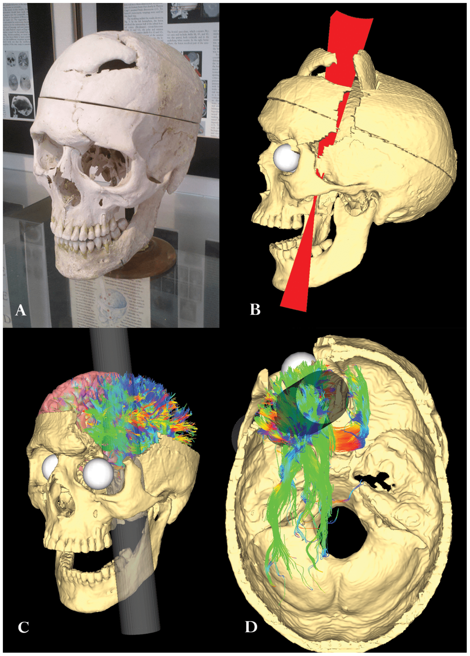 Simulazione del danno di Phineas Gage
